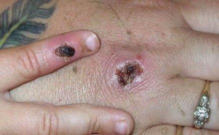 Bệnh đậu mùa khỉ