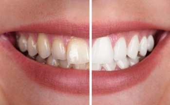 Lưu ý ngay sau khi tẩy trắng răng: 3 nhóm thực phẩm dễ làm răng bị xỉn màu trở lại