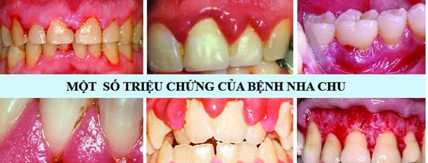 🦷 Bệnh nha chu ở người lớn tuổi: Mối nguy bị xem nhẹ