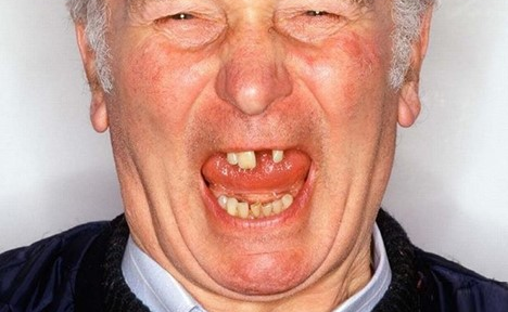 BỆNH NHA CHU VÀ SỨC KHỎE NGƯỜI CAO TUỔI