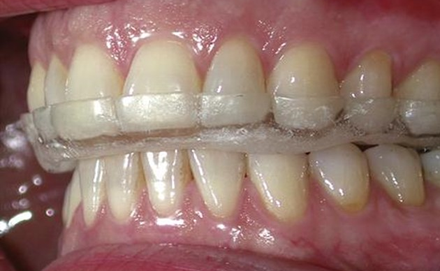 KHÍ CỤ MÁNG NHAI TRONG ĐIỀU TRỊ  RỐI LOẠN THÁI DƯƠNG HÀM