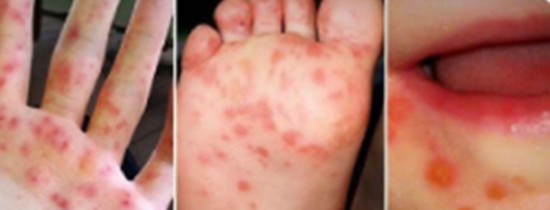 PHÒNG NGỪA TAY – CHÂN – MIỆNG CHO TRẺ EM