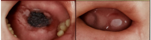 BỆNH SCORBUS – KẺ THÙ THẦM LẶNG TRONG KHOANG MIỆNG