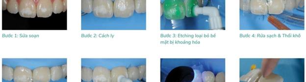 KÉM KHOÁNG HOÁ MEN RĂNG (MIH)