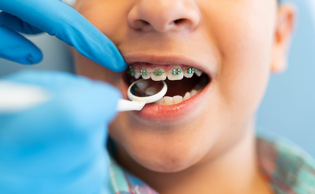 TẦM QUAN TRỌNG CỦA CHỈNH HÌNH RĂNG MẶT SỚM Ở TRẺ EM