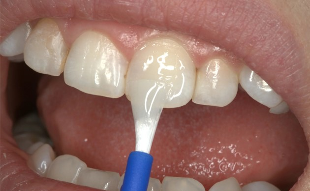 MỐI LIÊN QUAN GIỮA FLUORIDE VÀ SỨC KHỎE RĂNG MIỆNG