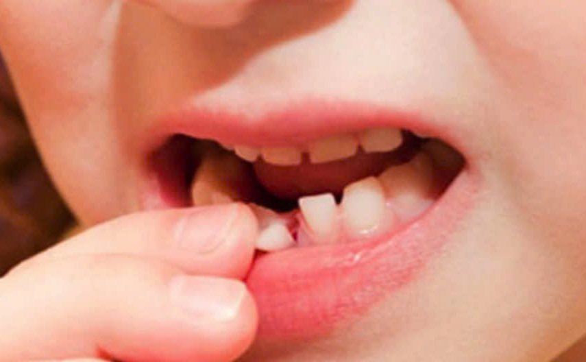 Ảnh hưởng của mất răng sữa sớm và cách phòng tránh