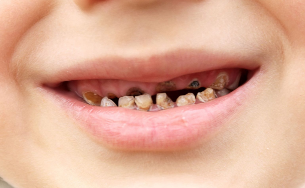 Sâu Răng Ở Trẻ Em: Nguyên Nhân, Tác Hại Và Cách Phòng Ngừa Hiệu Quả