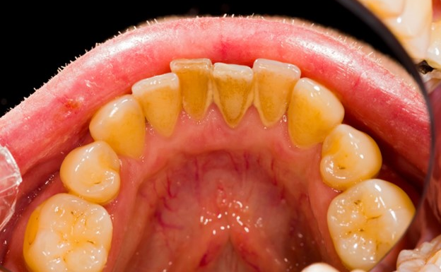 CAO RĂNG VÀ NHỮNG ĐIỀU BẠN CẦN BIẾT!