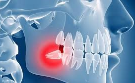 BIẾN CHỨNG CỦA RĂNG KHÔN MỌC LỆCH