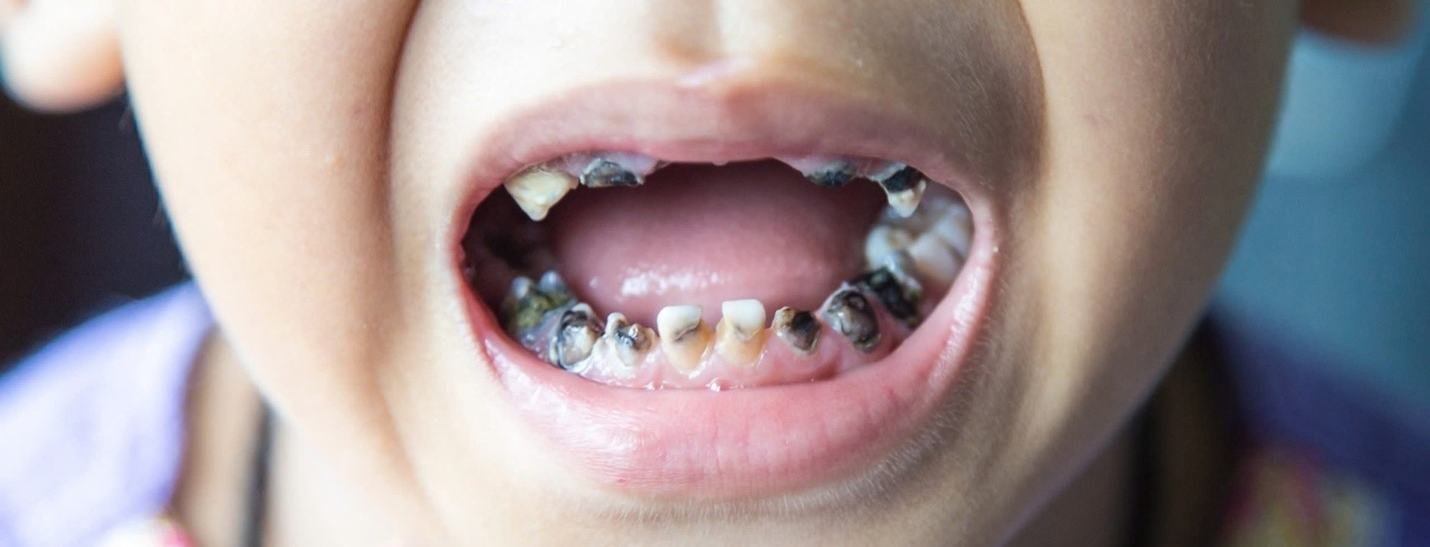 Vì sao cần giữ răng sữa cho trẻ đến đúng tuổi thay?