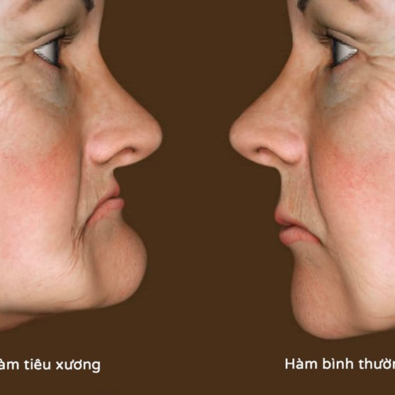 ĐIỀU GÌ XẢY RA KHI MẤT RĂNG Ở NGƯỜI LỚN TUỔI?