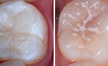 VAI TRÒ QUAN TRỌNG CỦA TRÁM BÍT HỐ RÃNH TRONG DỰ PHÒNG SÂU RĂNG Ở TRẺ EM