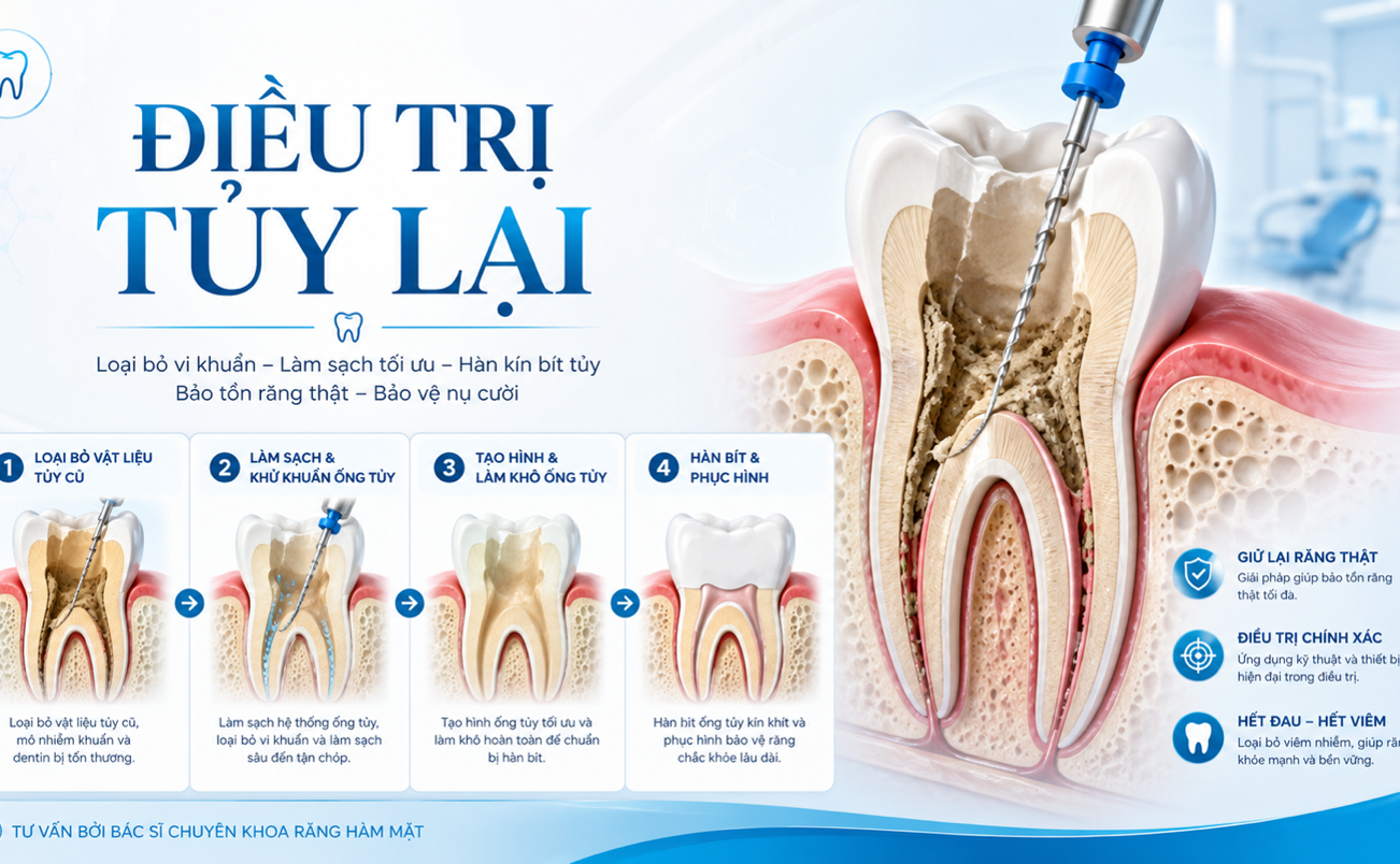 Điều trị tủy lại là gì? Khi nào răng đã chữa tủy cần điều trị lại?