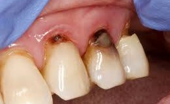 Sâu chân răng trong cộng đồng người cao tuổi