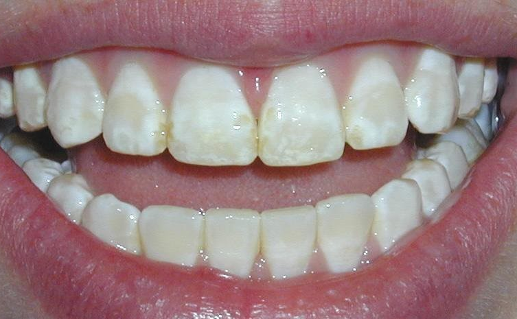 THIỂU SẢN MEN RĂNG: NGUYÊN NHÂN, ĐẶC ĐIỂM LÂM SÀNG, CHẨN ĐOÁN VÀ ĐỊNH HƯỚNG ĐIỀU TRỊ