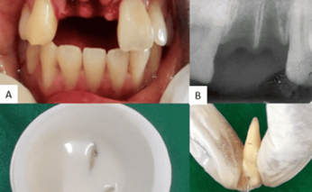 CHẤN THƯƠNG RĂNG Ở TRẺ EM – THỰC TRẠNG, NGUYÊN NHÂN VÀ HƯỚNG XỬ TRÍ