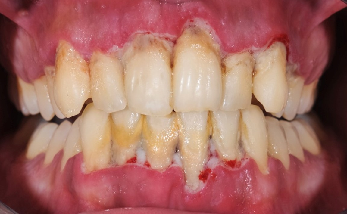 MỐI LIÊN QUAN GIỮA BỆNH LÝ VIÊM NHA CHU VÀ ĐÁI THÁO ĐƯỜNG