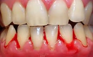 DỰ PHÒNG BỆNH LÝ VIÊM NƯỚU THAI KỲ