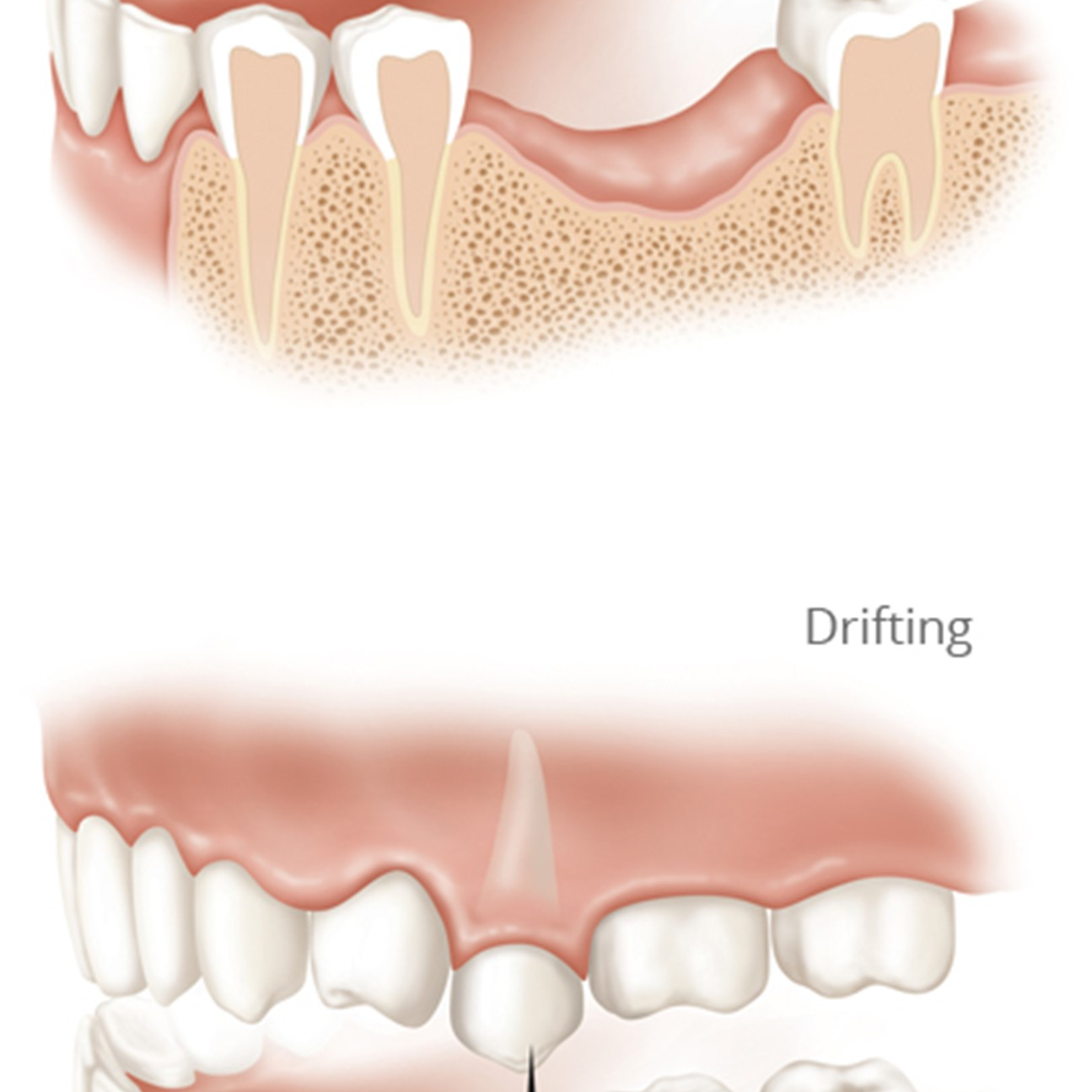Vì sao mất răng cần phục hồi sớm?