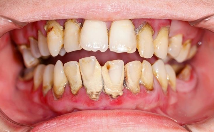 MỐI LIÊN QUAN GIỮA UỐNG RƯỢU BIA VÀ BỆNH LÝ NHA CHU