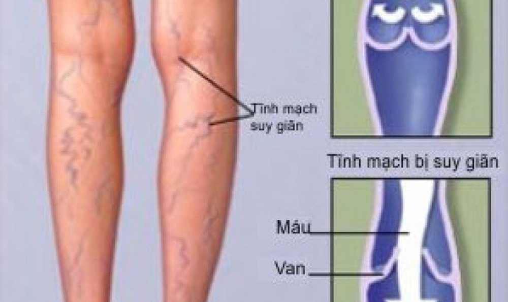 PHỤC HỒI CHỨC NĂNG CHO NGƯỜI BỆNH SUY GIÃN TĨNH MẠCH