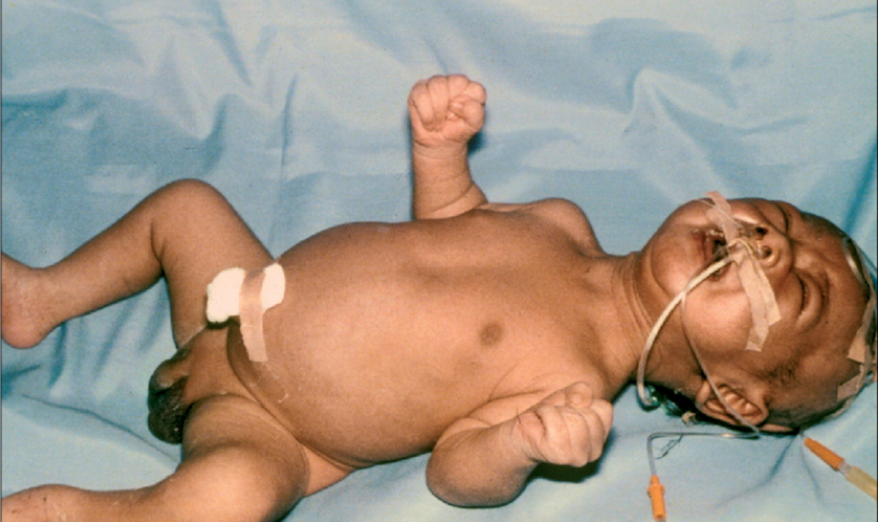 Các biện pháp phòng ngừa uốn ván trong cộng đồng