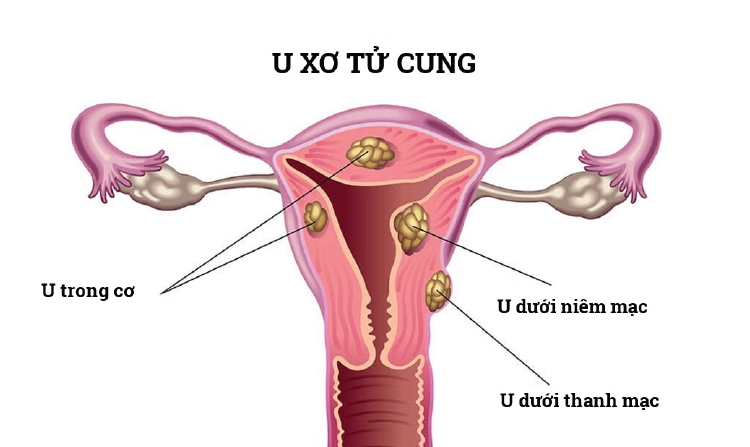 Hướng dẫn chẩn đoán và xử trí u xơ cơ tử cung