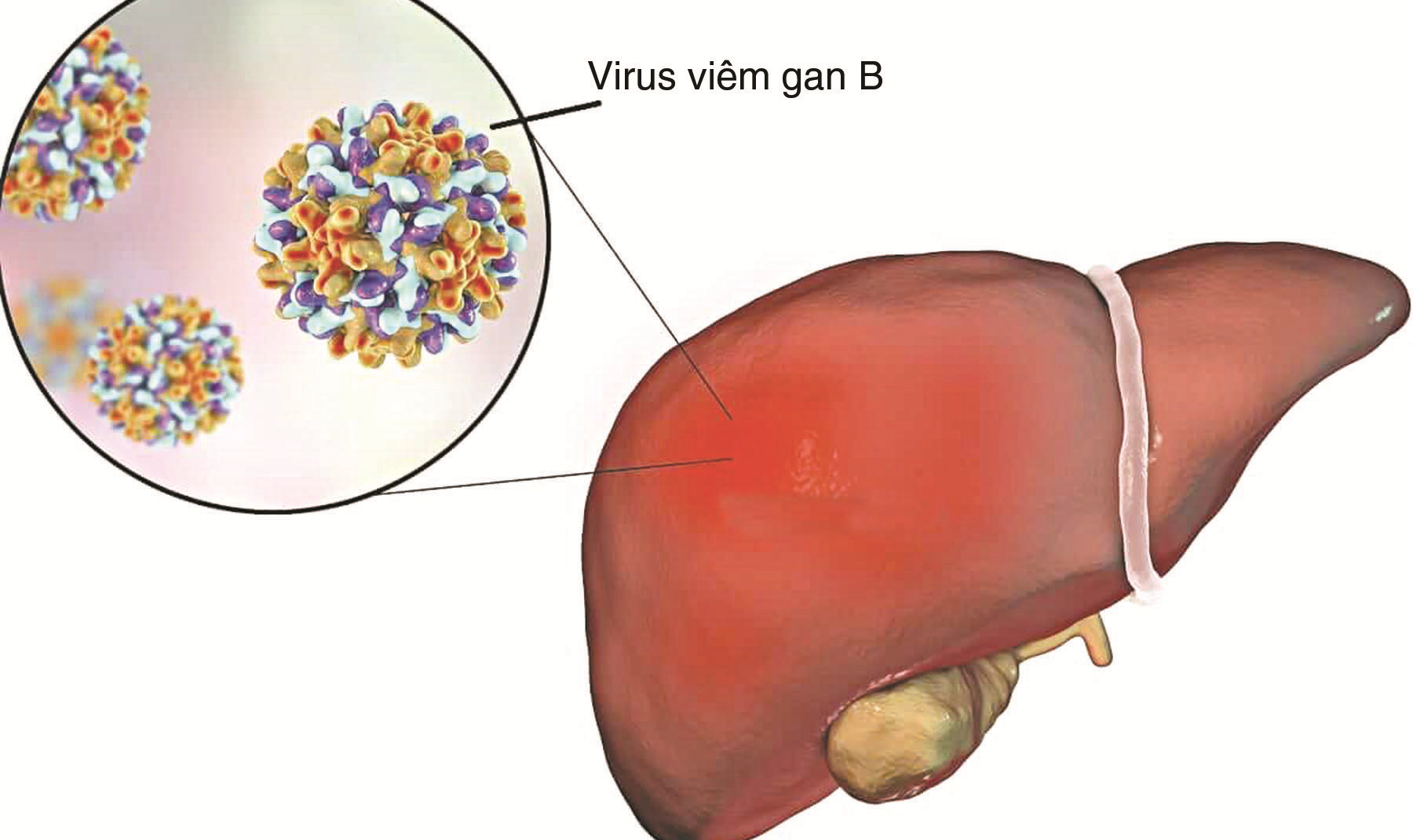 Hướng dẫn chẩn đoán, điều trị viêm gan vi rút B