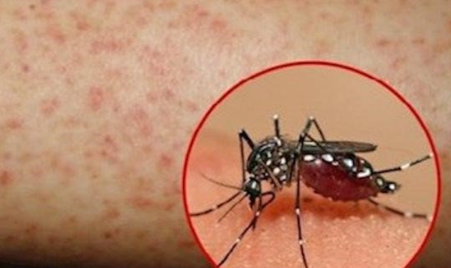 Sốt xuất huyết Dengue
