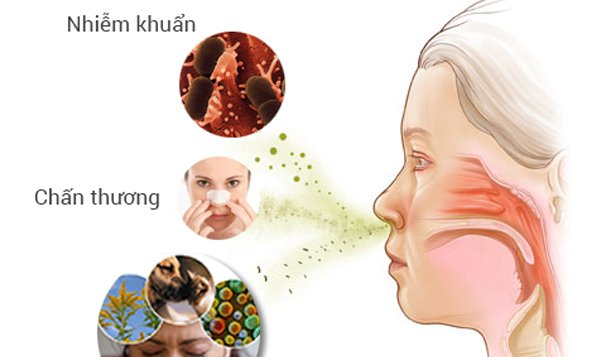 BẬC THANG TRONG ĐIỀU TRỊ VIÊM MŨI DỊ ỨNG
