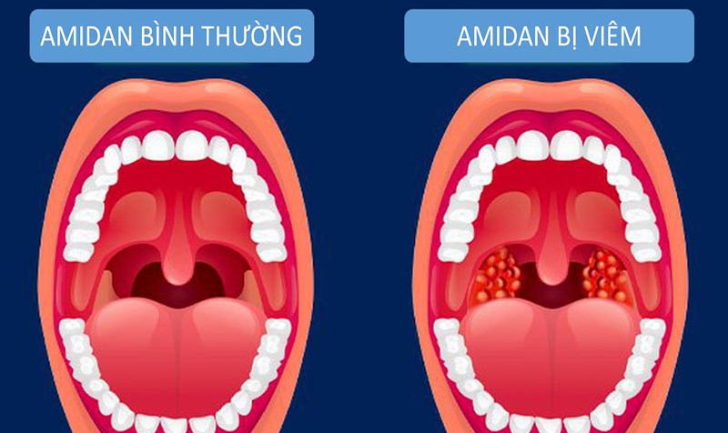 VIÊM AMIDAN - CHẨN ĐOÁN VÀ ĐIỀU TRỊ KHÔNG PHẪU THUẬT