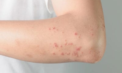 Dị ứng và quá mẫn