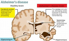 Hiểu Về Khoảng Cách Giới Trong Bệnh Alzheimer: Vì Sao Phụ Nữ Dễ Mắc Hơn Nam Giới?