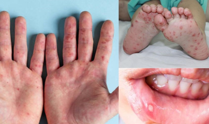 BỆNH TAY CHÂN MIỆNG: NHỮNG VẤN ĐỀ LÂM SÀNG VÀ Y TẾ CÔNG CỘNG