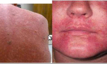 HỘI CHỨNG RED MAN