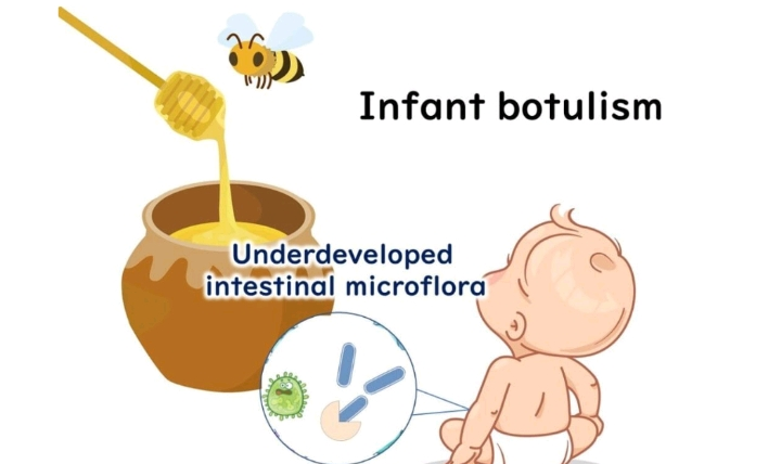 NGUY CƠ NGỘ ĐỌC BOTULISM TỪ MẬT ONG Ở TRẺ DƯỚI 1 TUỔI