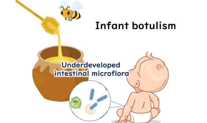 NGUY CƠ NGỘ ĐỘC BOTULISM TỪ MẬT ONG Ở TRẺ DƯỚI 1 TUỔI