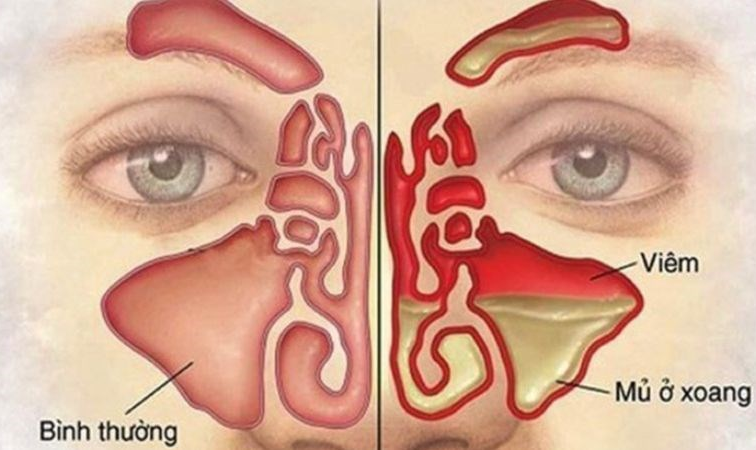 VAI TRÒ CỦA CORTICOSTEROIDS TẠI CHỖ TRONG  QUẢN LÝ VIÊM MŨI XOANG MẠN TÍNH