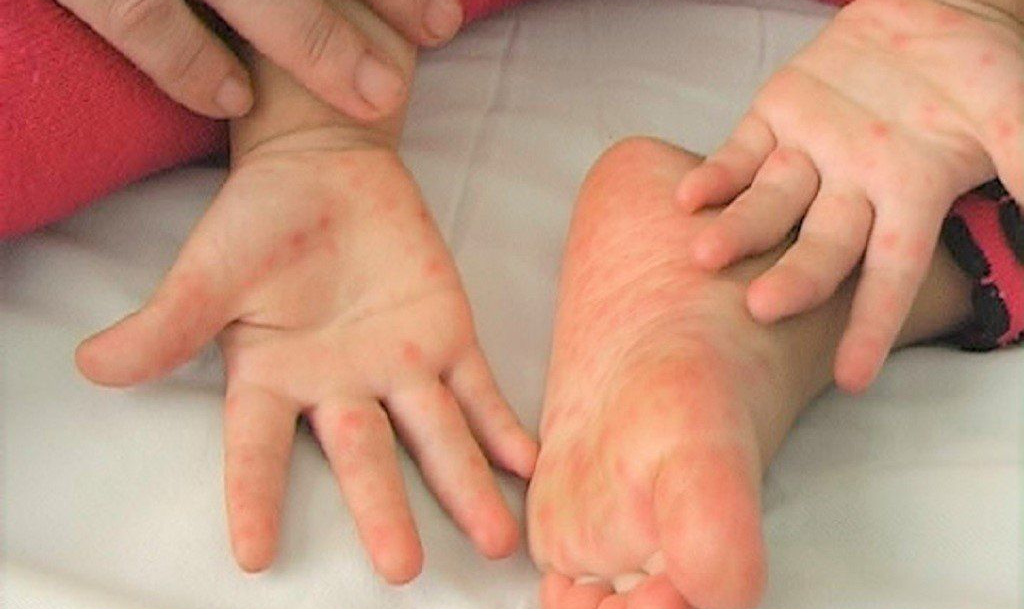 DỰ PHÒNG BỆNH TAY CHÂN MIỆNG