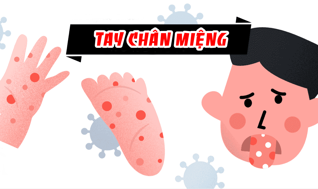 Bệnh tay chân miệng: Cập nhật đặc điểm lâm sàng, biến chứng và chiến lược phòng ngừa