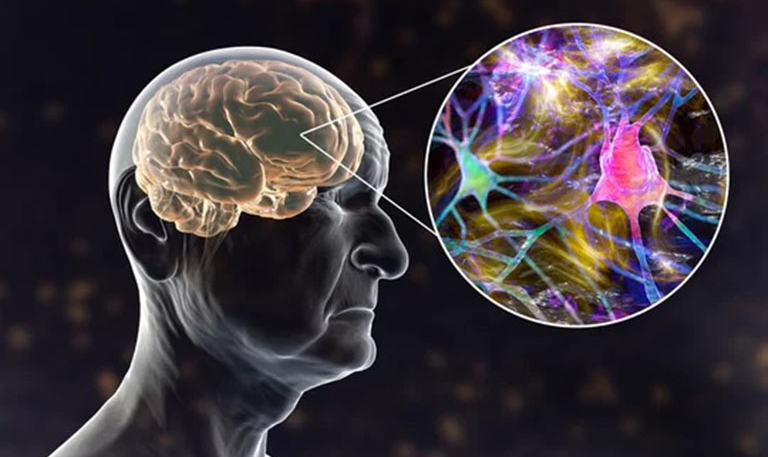 Sa sút trí tuệ (Dementia)
