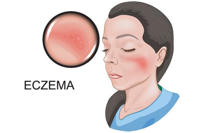 Một mục tiêu điều trị mới tiềm năng cho bệnh eczema
