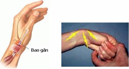 HỘI CHỨNG VIÊM GÂN VÙNG CỔ TAY, BÀN NGÓN TAY