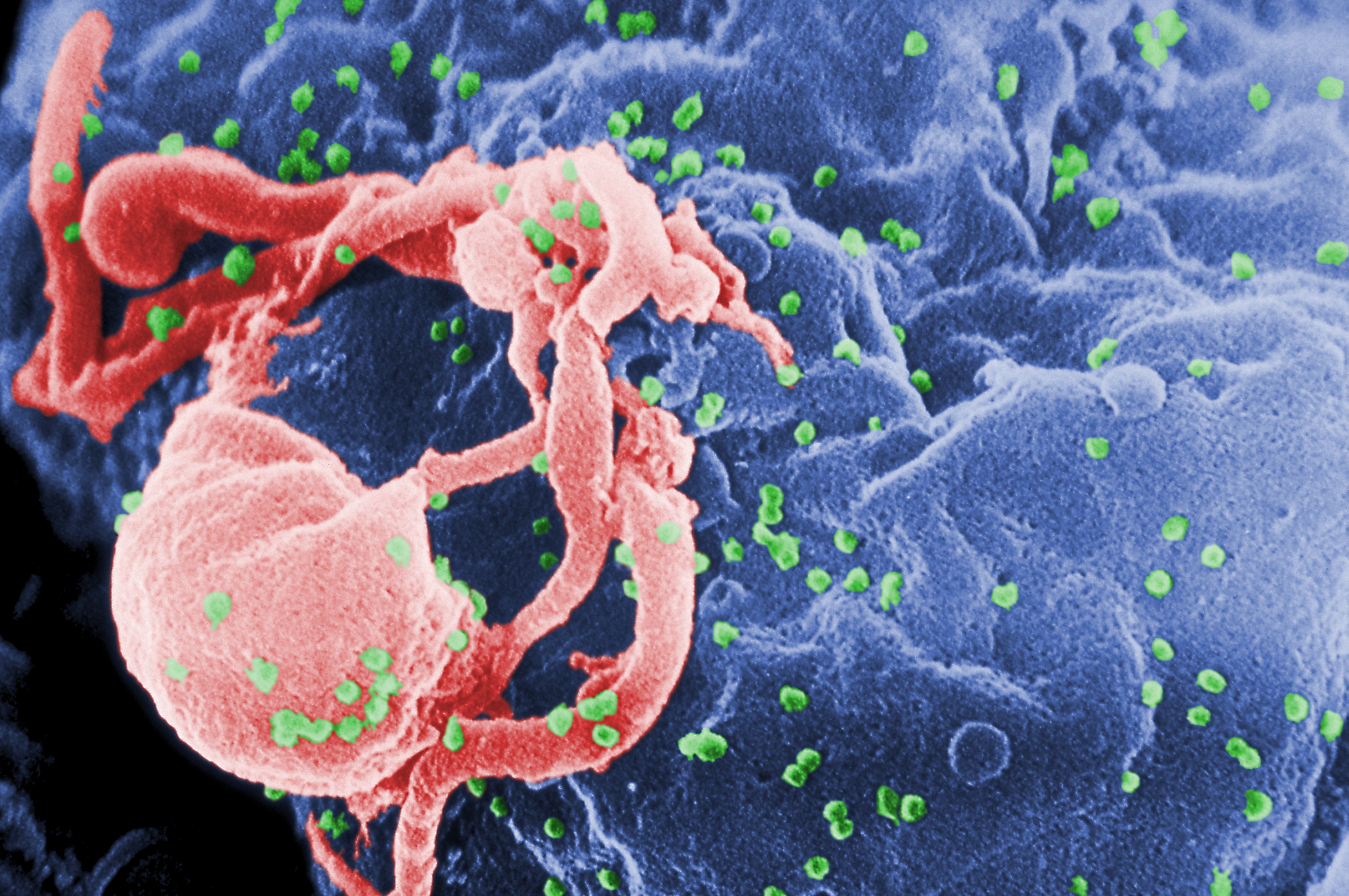 Phục hồi trao đổi chất cho bệnh nhân nhiễm HIV một phương pháp điều trị tiềm năng