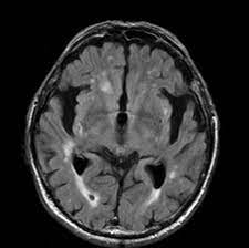 X-quang 3D tiết lộ tác động thần kinh của bệnh Alzheimer