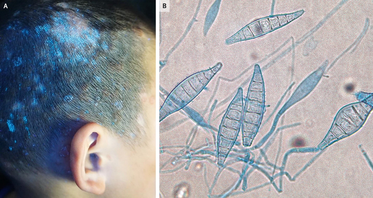 Nấm da đầu do Microsporum canis