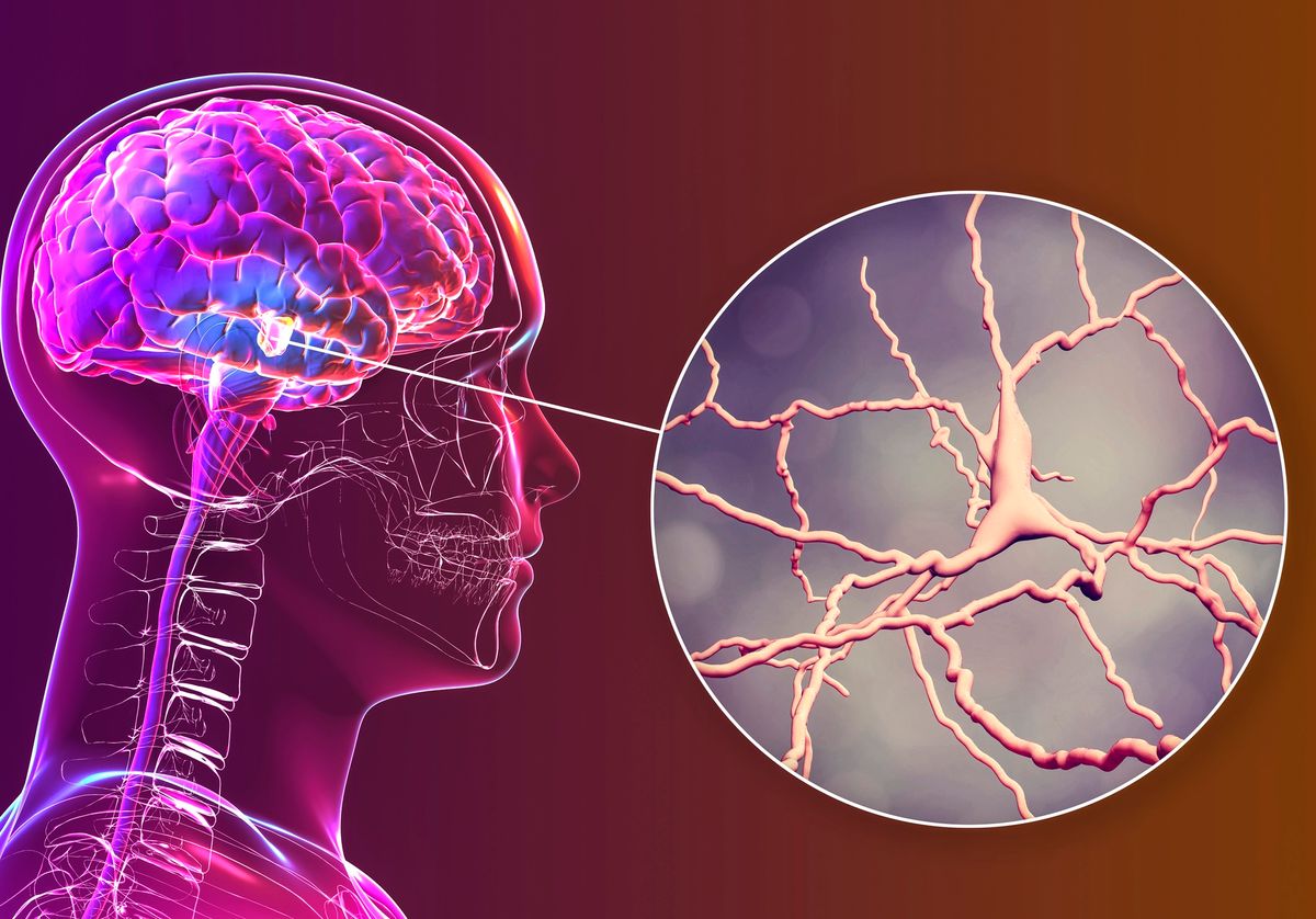 Một số tế bào não cụ thể liên quan đến bệnh Parkinson