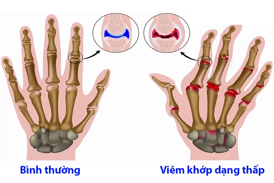 Viêm khớp dạng thấp (RA) là gì?