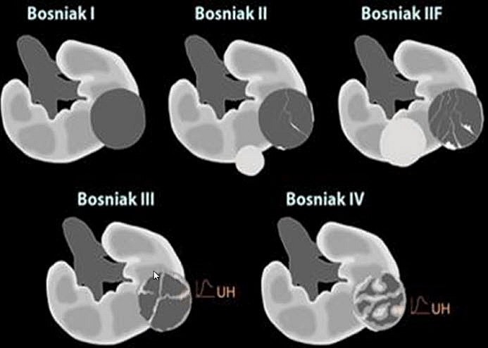 Hệ thống phân loại Bosniak của tổn thương dạng nang ở thận